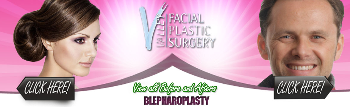 Blepharoplasty Plastic Surgery