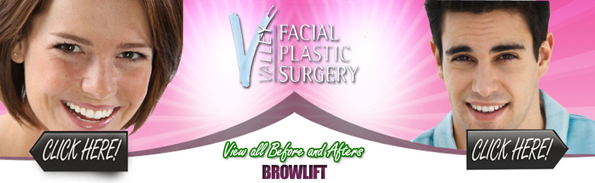 Brow Lift Facial Plastic Surgery