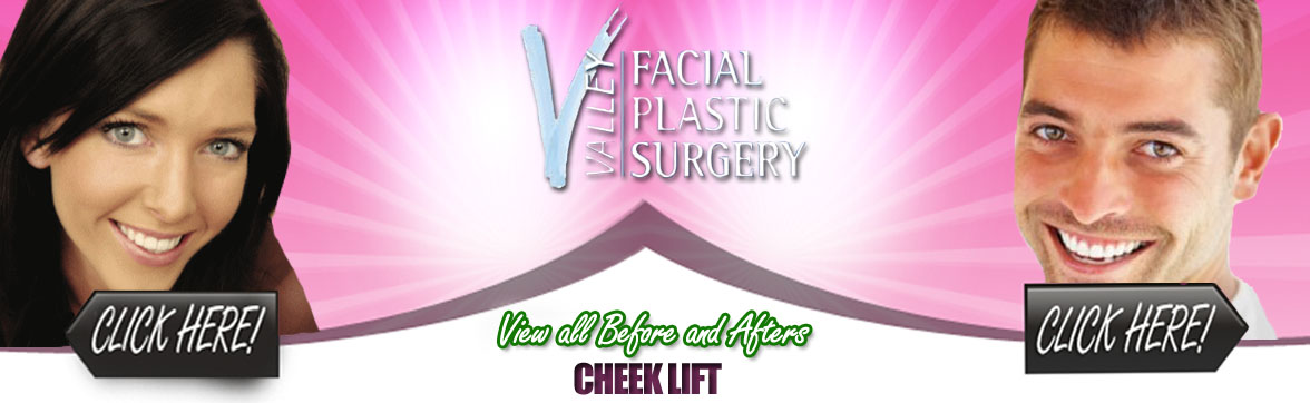 Cheek Lift Facial Plastic Surgery