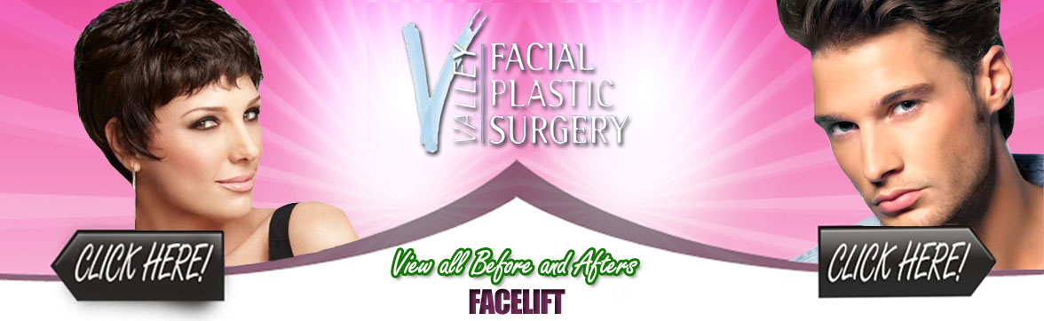 Face Lift | Facial Plastic Surgery