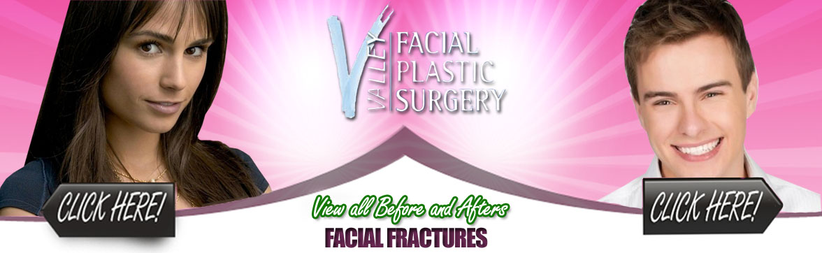 Facial Fractures | Facial Plastic Surgery 