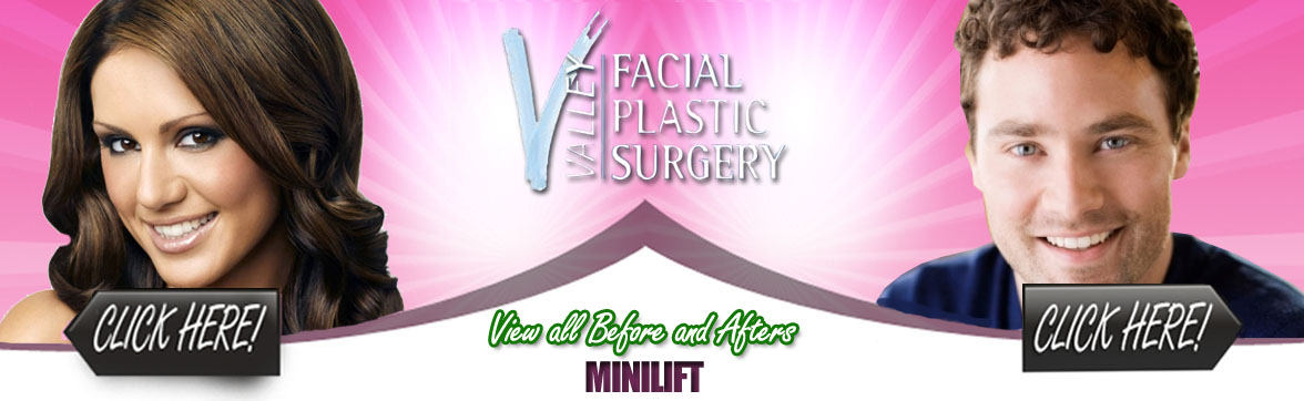 Mini Lift | Scottsdale Plastic Surgeon