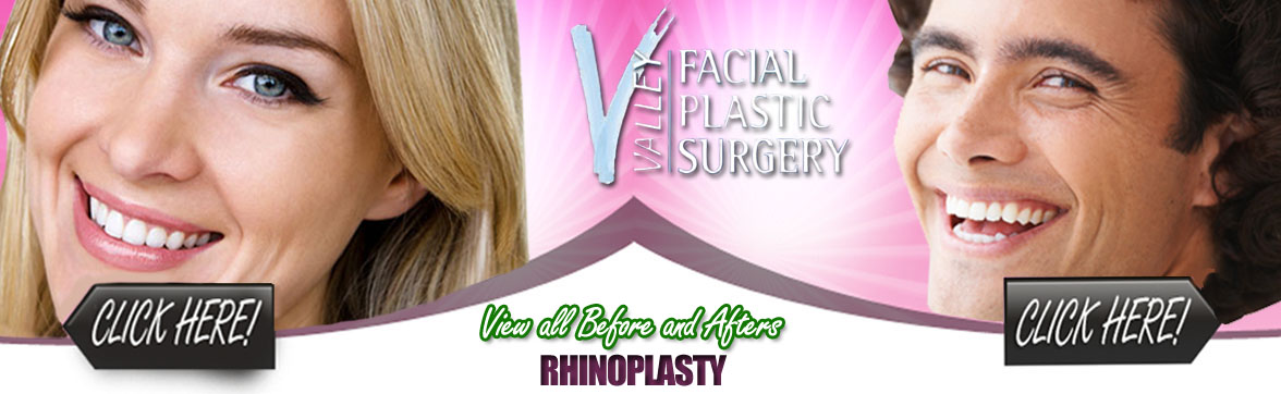 Rhinoplasty Surgery in Arizona