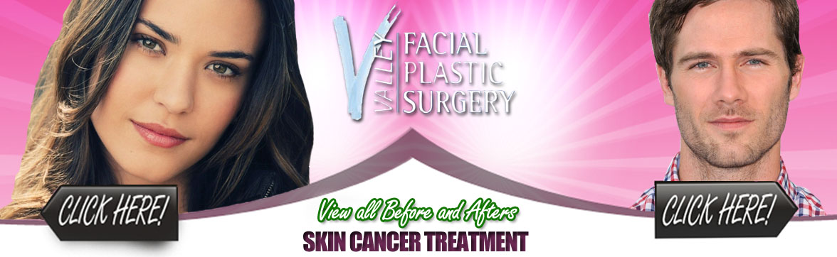 Plastic Surgery for Skin Cancer Treatment